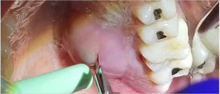 Dental abscess popping